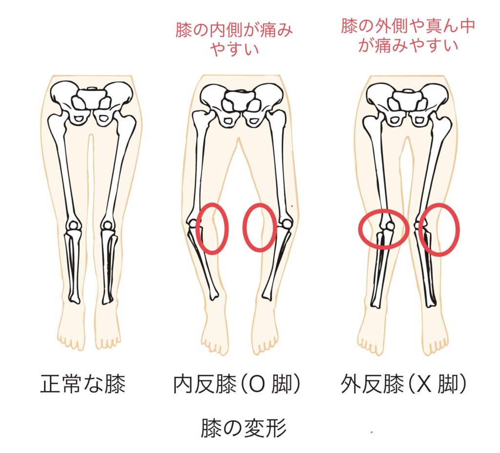 姿勢改善　膝痛改善　内転筋　ハムストリング　Ｏ脚　内股　Ｘ脚　オスグット　変形性膝関節症